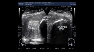 A Large Fibroid with a large Ovarian Cyst [upl. by Ahcsap]