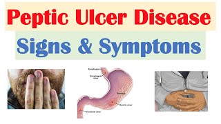 Peptic Ulcer Disease Signs amp Symptoms  Gastric vs Duodenal Ulcers [upl. by Sirama375]