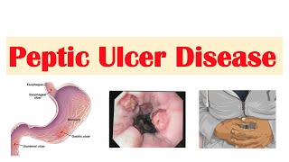 Peptic Ulcer Disease Gastric vs Duodenal Ulcers  Causes Symptoms Diagnosis Treatment [upl. by Daffie]