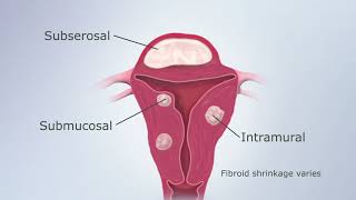 What are Fibroids its diagnosis amp management  Dr B Ramesh [upl. by Dickerson]