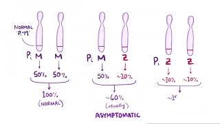 Alpha 1 Antitrypsin Deficiency causes symptoms diagnosis treatment pathology [upl. by Eyk450]