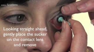 GP contact lens removal with sucker [upl. by Anirbed]