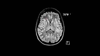 MS white matter lesions  First Look MRI [upl. by Aserehtairam]