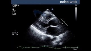 TheEchoWeb  Perimembranous Ventricular Septal Defect [upl. by Pierrette]