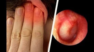 Infections aux oreilles  comment les soigner [upl. by Sianna]