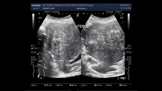 Ultrasound Video showing Fibroid with Ovarian Cyst [upl. by Thurmond]