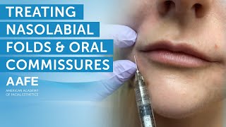 Using Dermal Fillers to Fill and Smooth Smile Lines  AAFE [upl. by Nigen265]