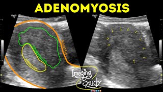 FIBROIDS AND ADENOMYOSIS [upl. by Orman117]