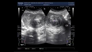 Myths amp Misconceptions Understanding Endometriosis and Uterine Fibroids Webinar [upl. by Felise]