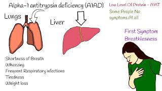 Frequent Bronchitis Emphysema in Youngs Alpha1 Antitrypsin Deficiency [upl. by Codee]