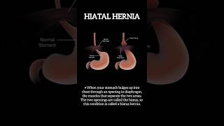 Hiatus hernia I Treatment for hiatus hernia in Delhi [upl. by Donn]