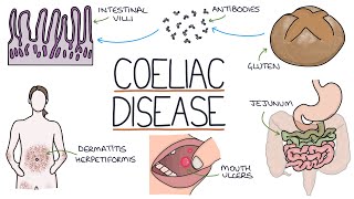 EARLY DIAGNOSIS  COELIAC UK [upl. by Ahsitnauq364]