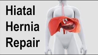 Hiatal Hernia Repair Animation [upl. by Arabela]