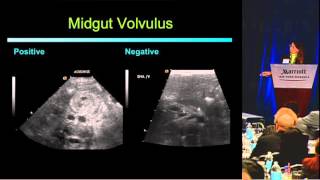 HIFU High intensity focused ultrasound for fibroid [upl. by Bornie]