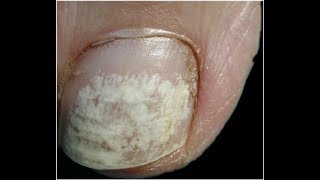 Keratin Granulations  White Toenails Best Home Treatment [upl. by Ophelia633]