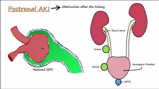 Acute Kidney Injury AKI  PrerenalIntrarenalPostrenal [upl. by Maurey]