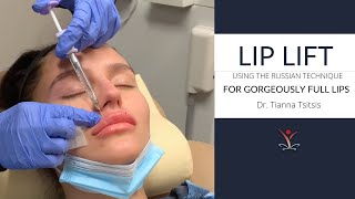 Lip Filler Lip Lift with the Russian Technique [upl. by Carlotta]