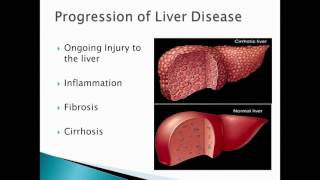 Alpha1 Antitrypsin Deficiency 101 Liver [upl. by Oirevas]