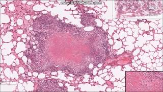 Tuberculosis Granulomas  Histopathology slides [upl. by Arrahs]