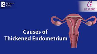 Ultrasound Video showing Two Fibroids one is Calcified Fibroids [upl. by Eniamaj]