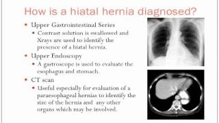 Hiatal Hernias [upl. by Ani]