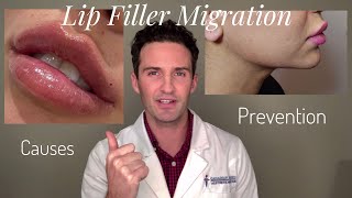 Lip Filler Migration Causes amp Prevention [upl. by Atalante]