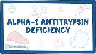 Alpha1 Antitrypsin Deficiency  causes symptoms diagnosis treatment pathology [upl. by Travax606]