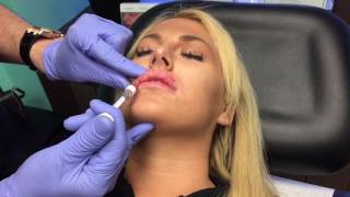 Microdroplet lip injection Using Restylane Juvederm [upl. by Zitella]