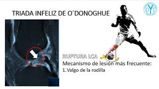 Triada infeliz de O´donoghue [upl. by Atlante]