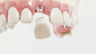 Introducing DIO Multiunit Abutment [upl. by Ragnar897]