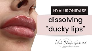 Dissolving Lip Filler [upl. by Eyaj]