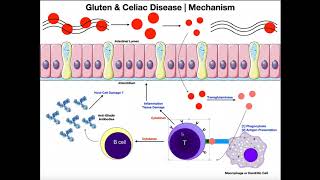 Coeliac Celiac Disease  Overview signs and symptoms pathophysiology diagnosis treatment [upl. by Gustave]