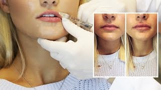 Lip Filler Experience  Start to Finish with 1 Syringe of Juvederm [upl. by Bartholomew802]