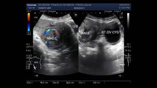 Two cases of Cervical Mass Fibroids and Ovarian Cyst [upl. by Anoyi]