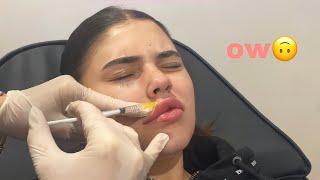 i got my lip filler dissolved [upl. by Randa]