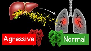 Alpha1 Antitrypsin Deficiency  Signs Causes Treatment and Prognosis [upl. by Ecnaiva]